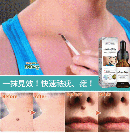 德國最新配方!【皮膚科醫師推薦】EELHOE 點痣克疣精華液