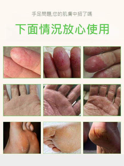 香港大藥房手足脫皮護膚膏