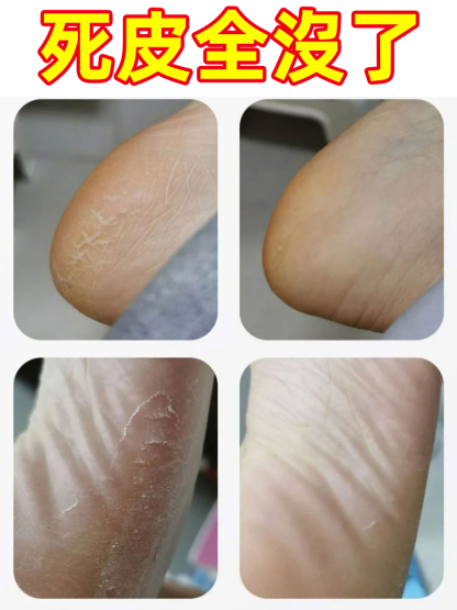 【輕鬆去死皮】數位電動磨腳器