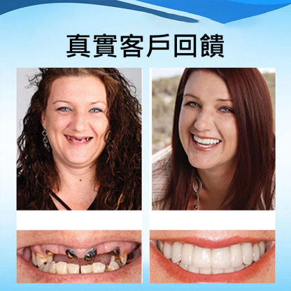 完美微笑假牙套裝