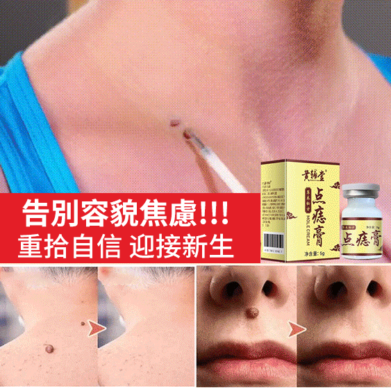 濃縮強效點痣去疣膏