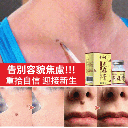 濃縮強效點痣去疣膏