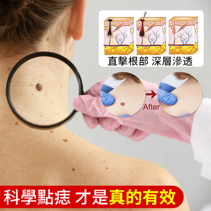 濃縮強效點痣去疣膏