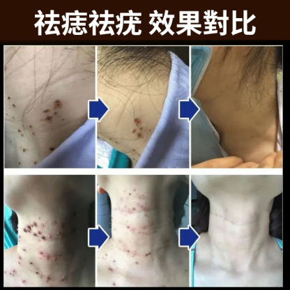 濃縮強效點痣去疣膏