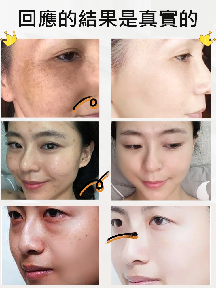 【老斑黃斑一抹消】淡斑尿素霜