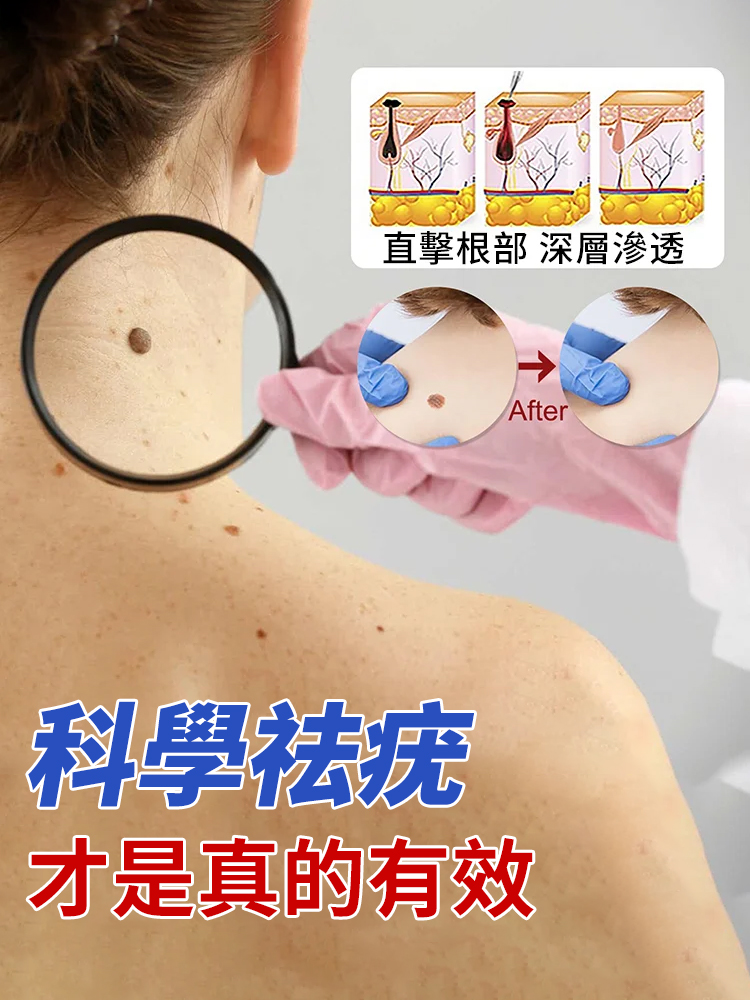 【3天見效】祛疣型醫用凝膠
