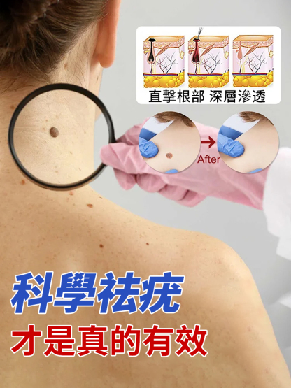 【3天見效】祛疣型醫用凝膠