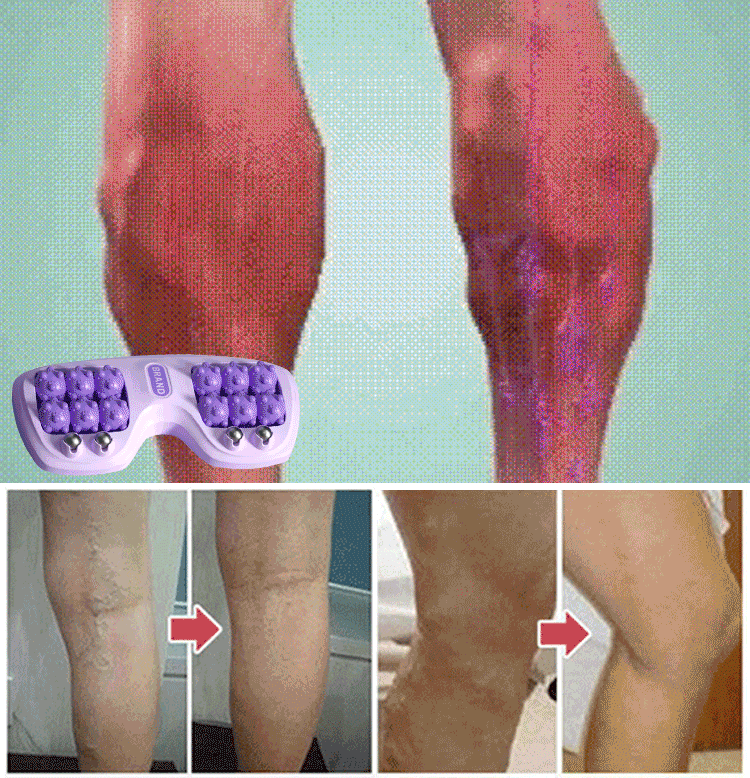穴位磁療滾輪腳底按摩器