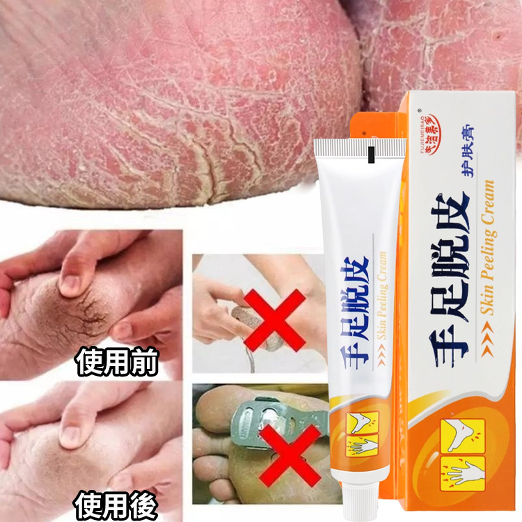 【脫皮專用】手足脫皮抑菌膏