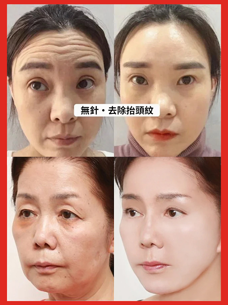 抗皺不用等！這款精華液水光感滿滿，塗抹瞬間吸收不黏膩，針對抬頭紋、法令紋精准撫平，肌膚越用越緊緻