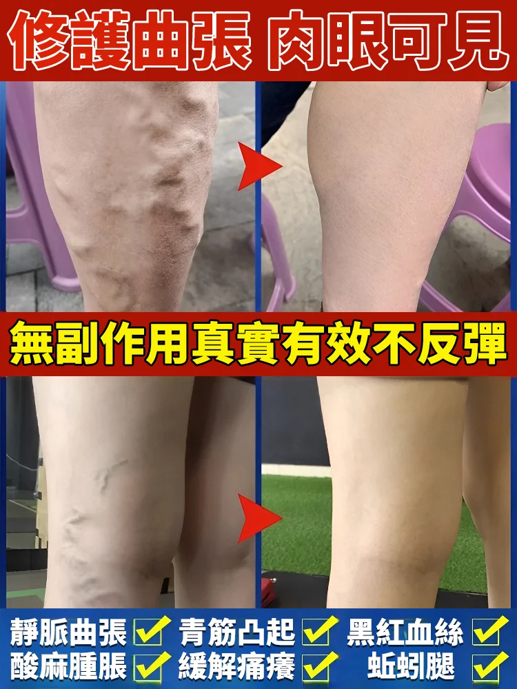 一抹疏通✦高效型靜脈曲張凝膠