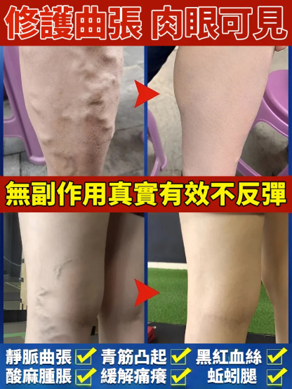 一抹疏通✦高效型靜脈曲張凝膠