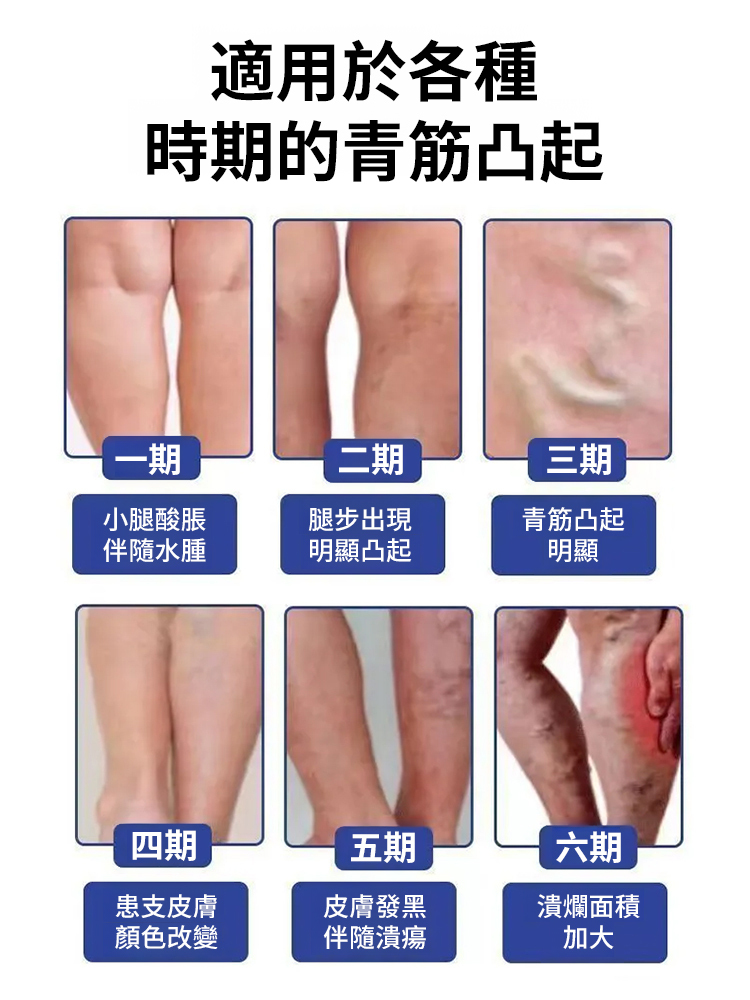 靜脈曲張醫用退燒凝膠