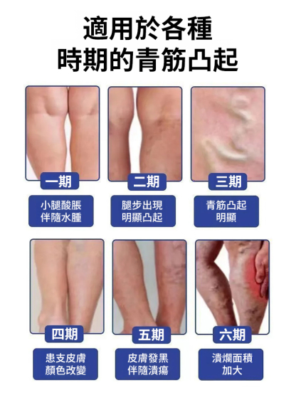 靜脈曲張醫用退燒凝膠