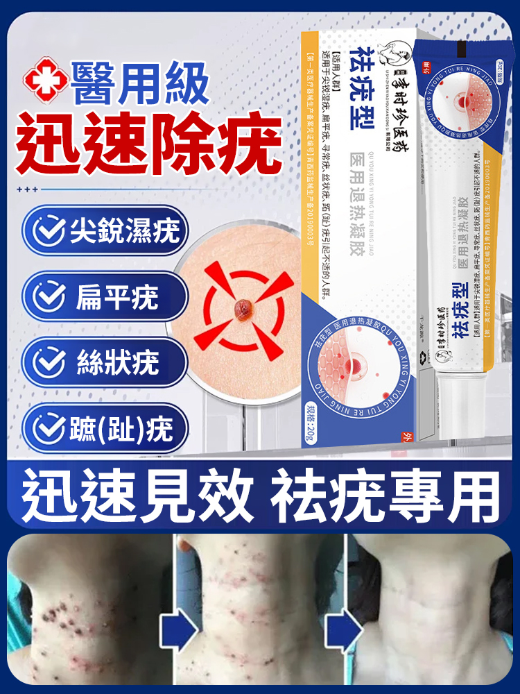 【3天見效】祛疣型醫用凝膠