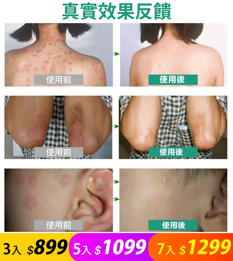 日本配方頑毒凈乳膏