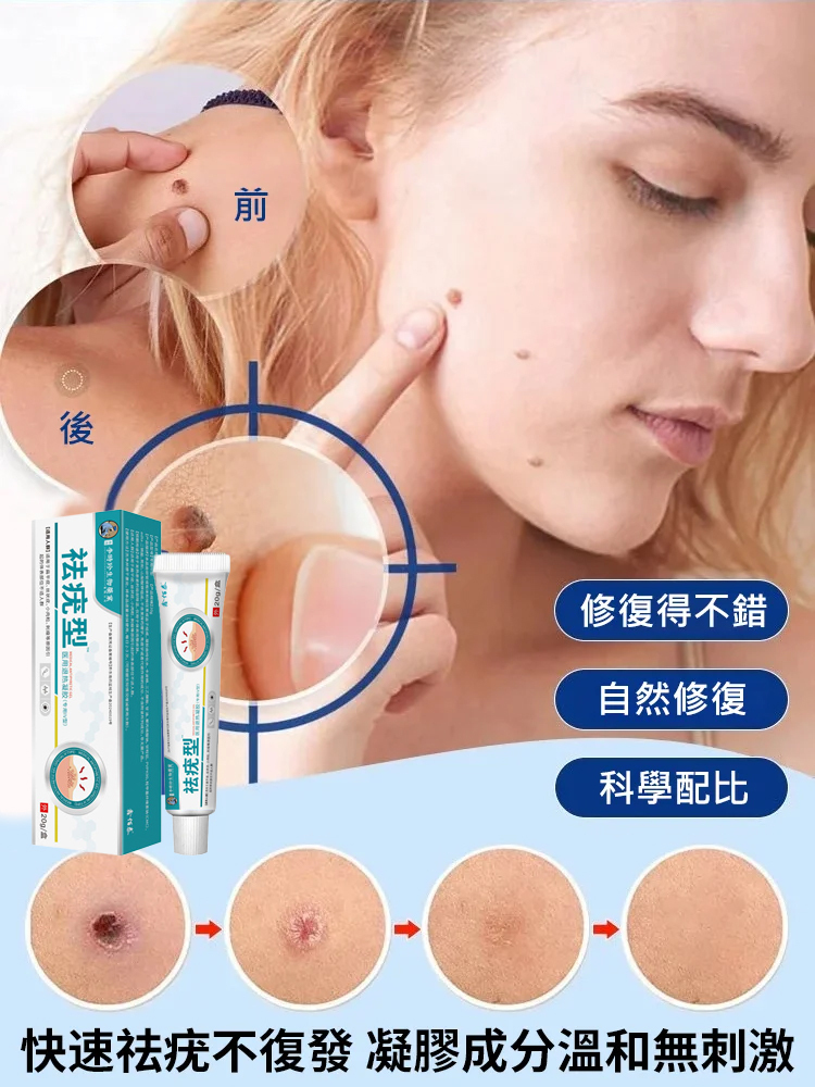 【除疣一抹靈】醫用退熱凝膠疣清寧