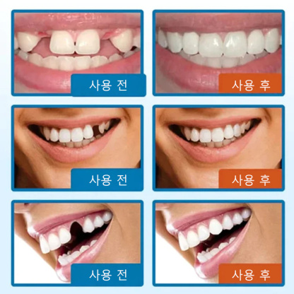 South Moon 임시 구강용 접착제