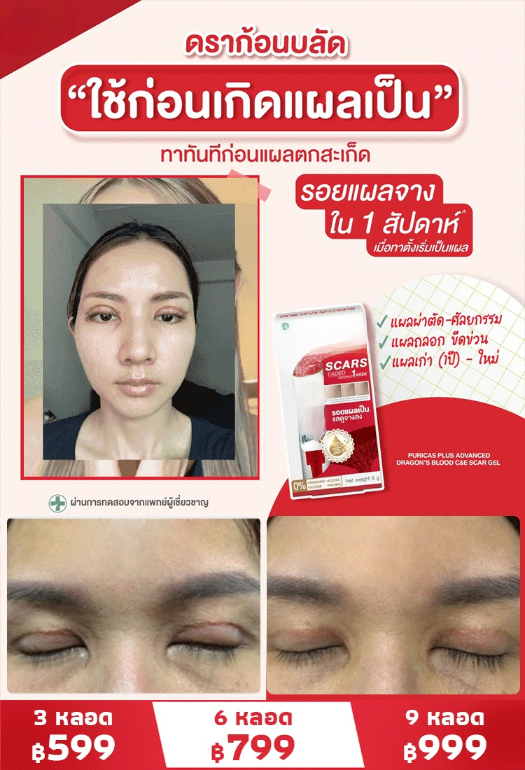 เจลลดรอยแผลเป็นทางการแพทย์