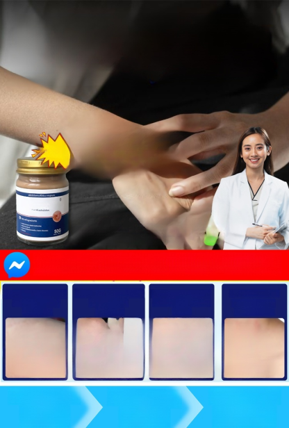 【เห็นผลทันที! รักษาถาวร!】ครีมรักษาโรคด่างขาว