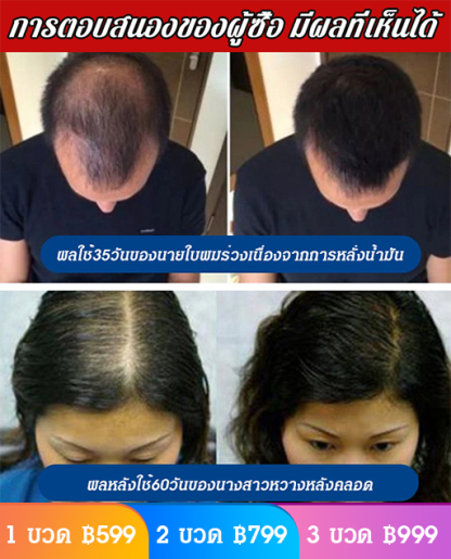 [ปลูกผมใหม่ได้ใน 30 วัน] Ginger King Hair Growth Shampoo