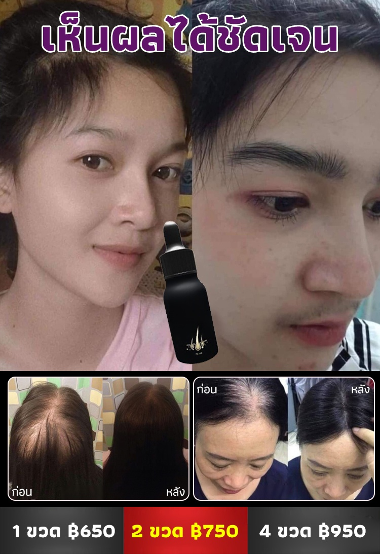 【ผมหนาขึ้น】น้ำมันหอมระเหยปแลูกผมป้องกันผมร่วง