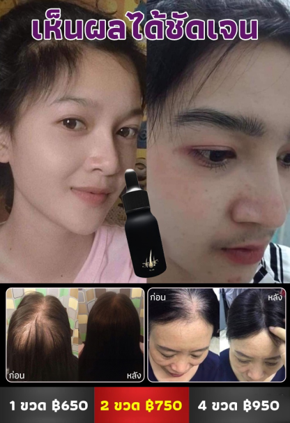 【ผมหนาขึ้น】น้ำมันหอมระเหยปแลูกผมป้องกันผมร่วง