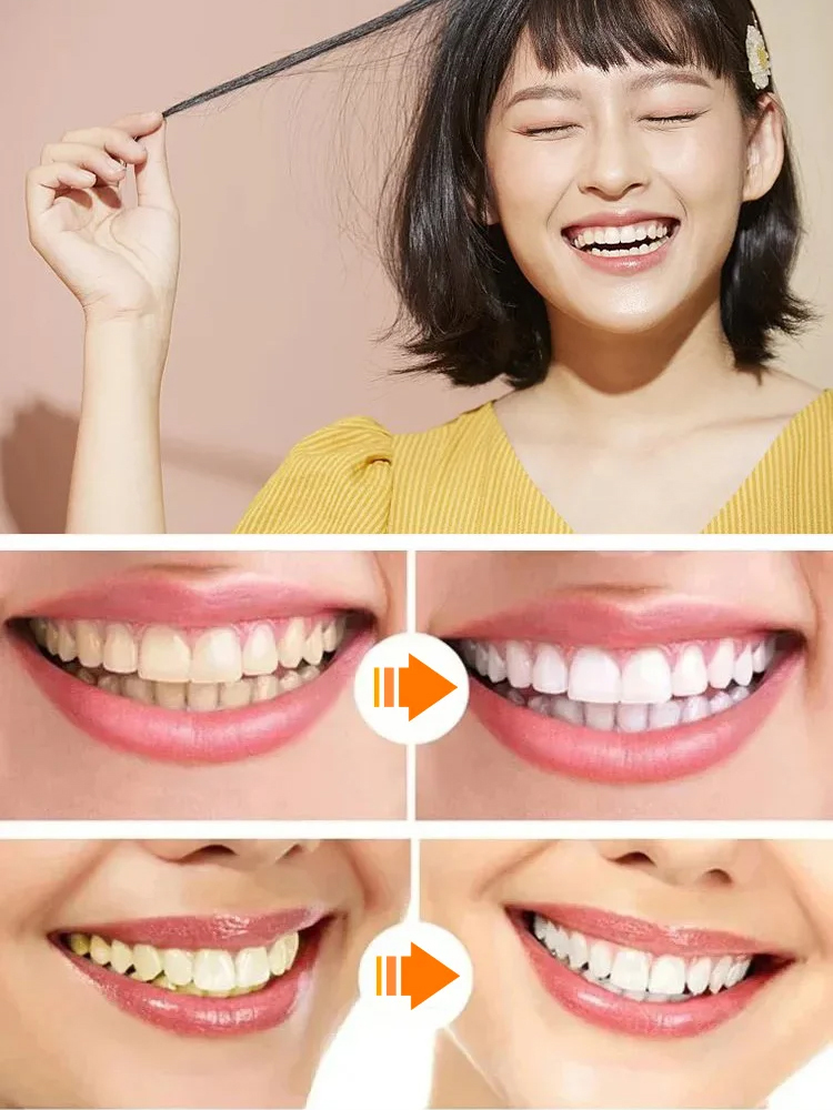 着脱可能な美白付け歯