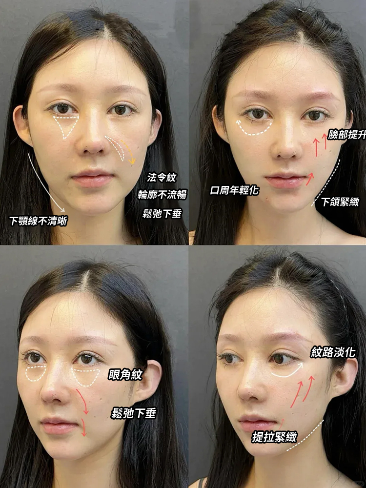 【年輕十歲】全臉提拉抗皺玻尿酸微晶貼