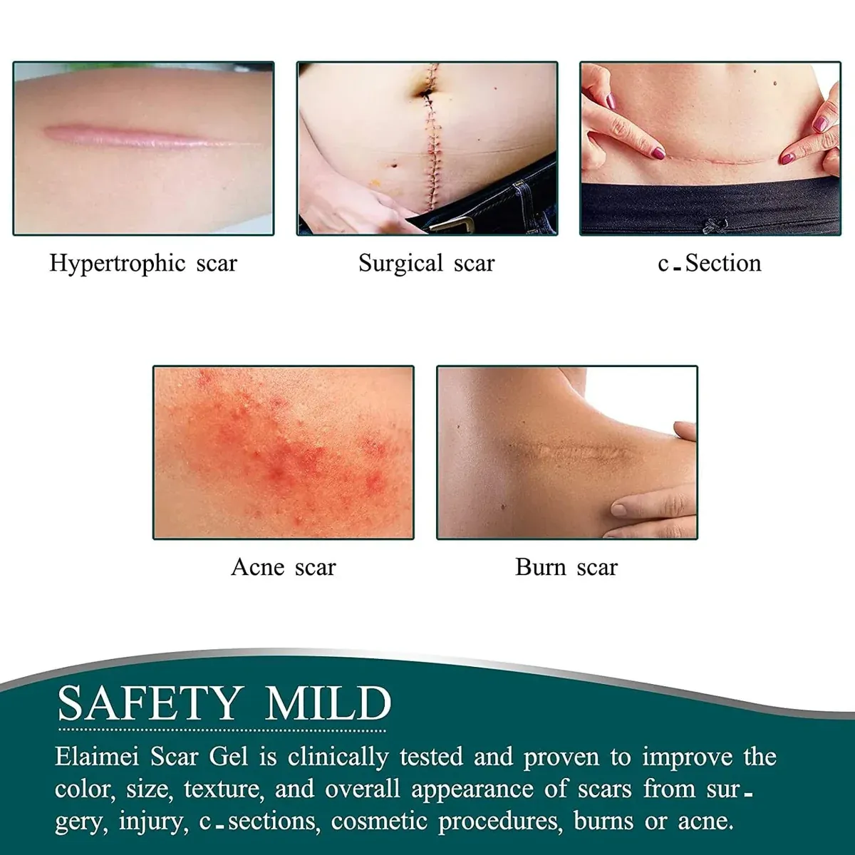 Silicone Scar Removal Tape @ Just Rs.599/-
