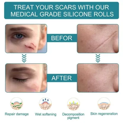 Silicone Scar Removal Tape @ Just Rs.599/-