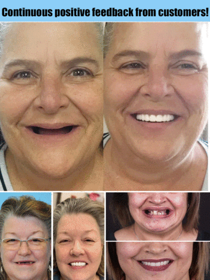 Silicone simulation temporary dentures