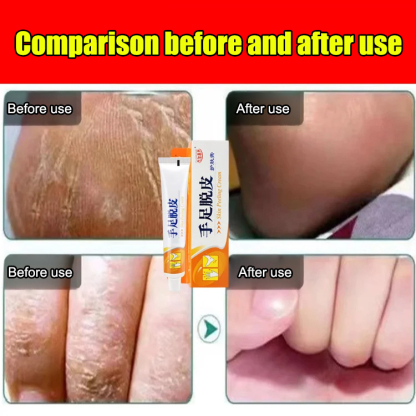 [Special for peeling] Antibacterial cream for hands and feet