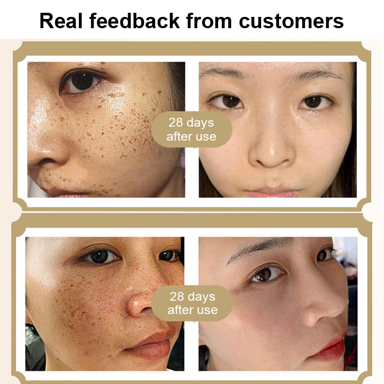 Freckle removal astragalus cream