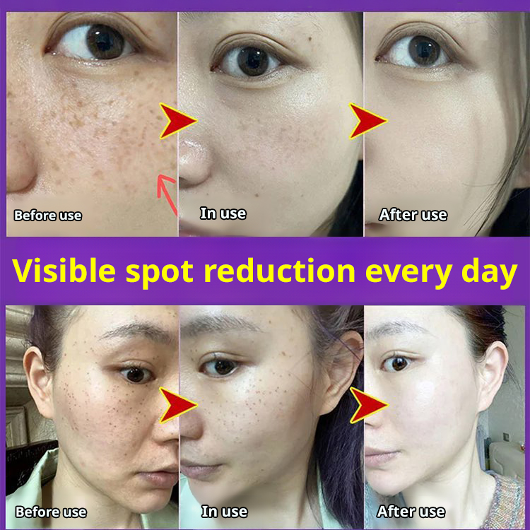 Niacinamide Whitening Anti-Freckle Cream