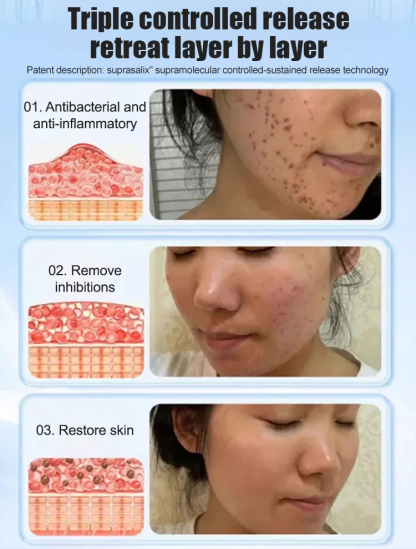 【Wart Removal Cream】Medical Cooling Gel Wart Clear