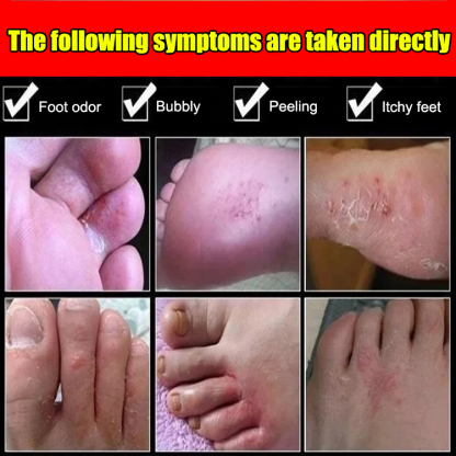 [Special for peeling] Antibacterial cream for hands and feet