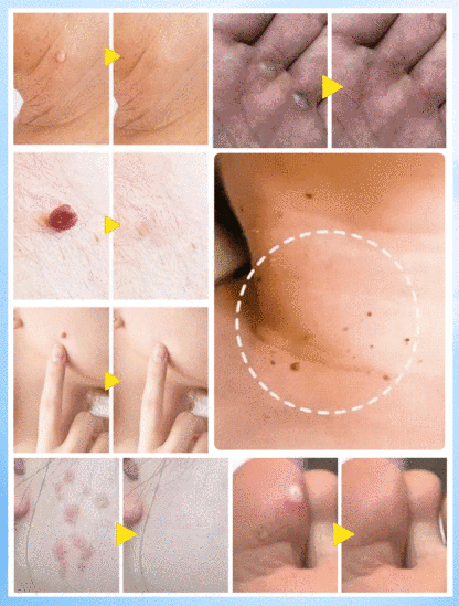 【Wart Removal Cream】Medical Cooling Gel Wart Clear