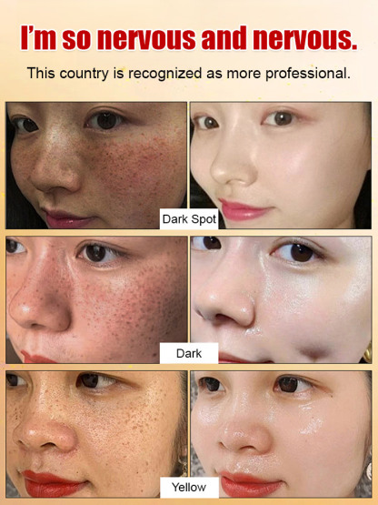 [Specially for stubborn spots] Upgraded anti-freckle essence oil