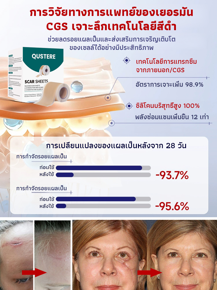 แผ่นเจลซิลิโคนลดรอยแผลเป็นแบบต่อเนื่อง 24 ชั่วโมง