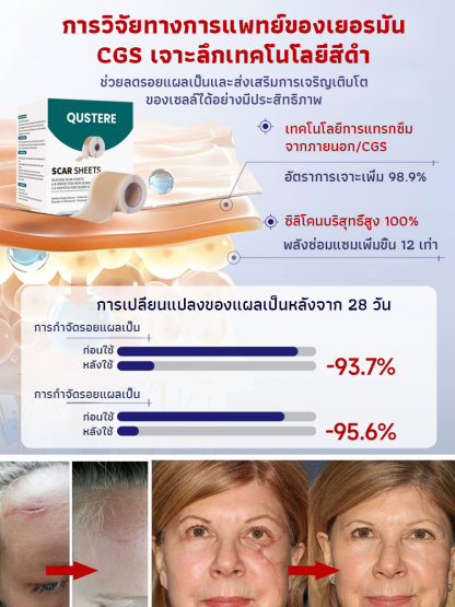 แผ่นเจลซิลิโคนลดรอยแผลเป็นแบบต่อเนื่อง 24 ชั่วโมง