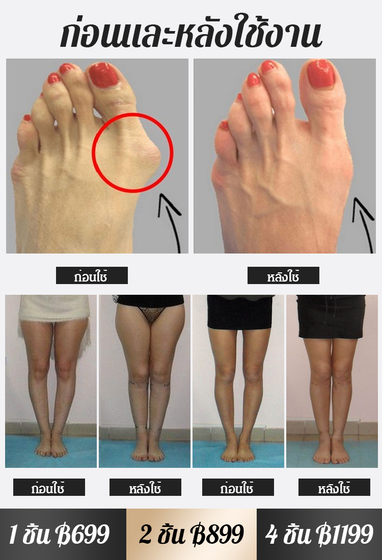 อุปกรณ์แก้นิ้วโป้งเท้าเกผ้าตาข่าย the love 