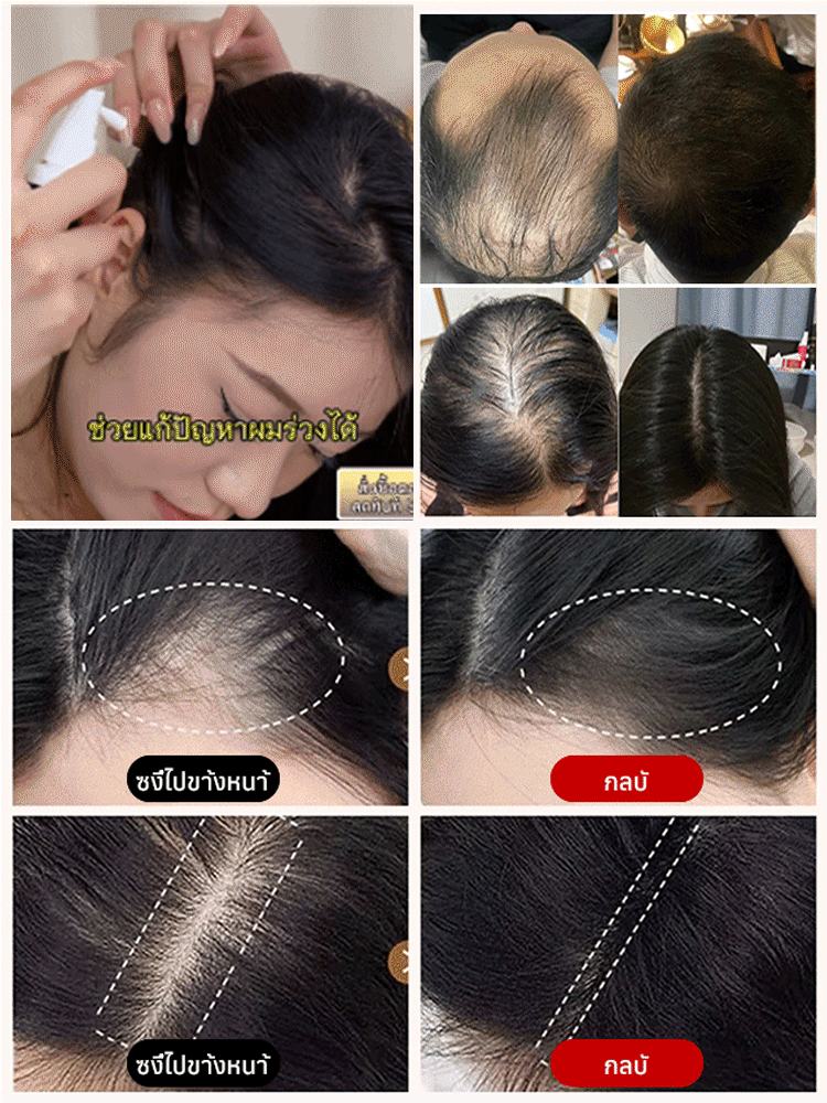 【สเปรย์พืชป้องกันผมร่วงและกระตุ้นการเจริญเติบโตของผม】