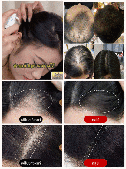 【สเปรย์พืชป้องกันผมร่วงและกระตุ้นการเจริญเติบโตของผม】