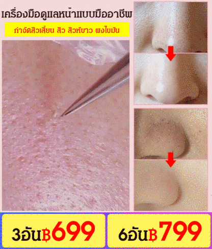 แหนบดึงสิวเสี้ยนสแตนเลส