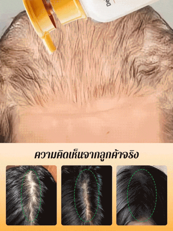 【1 แชมพูเพิ่มปริมาณสองเท่า】แชมพูป้องกันผมร่วง
