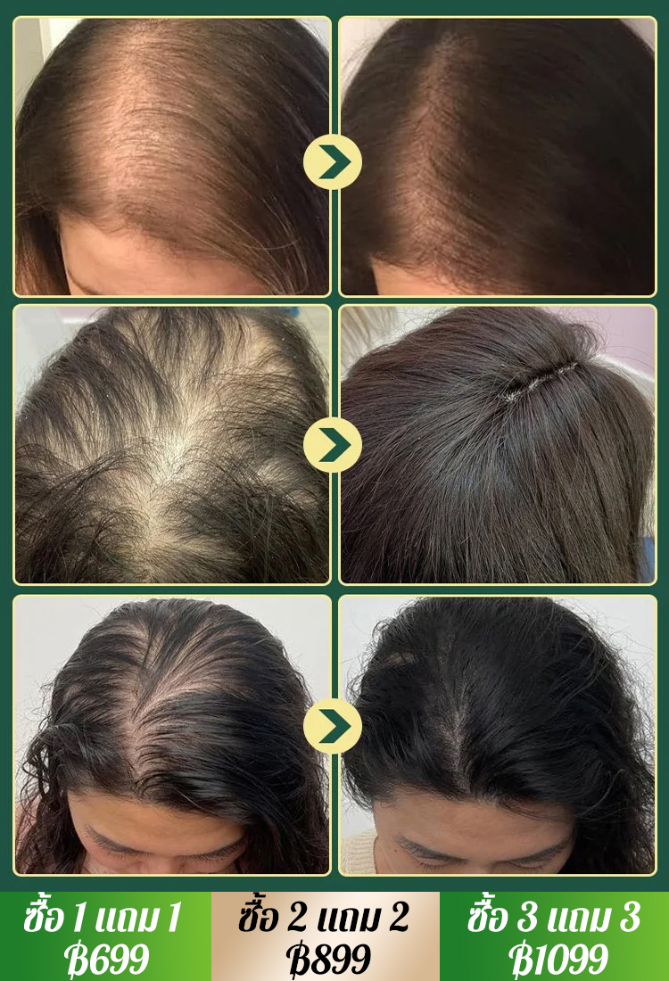 【ยิ่งผมบางยิ่งเห็นผลดี】แชมพูบำรุงและฟื้นฟูผมด้วยสารสกัดจากสมุนไพร