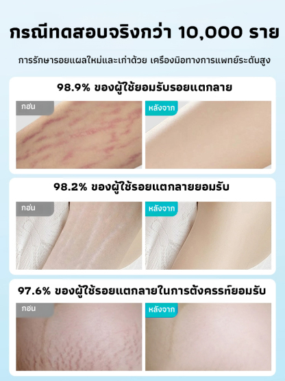 แผ่นเจลซิลิโคนลดรอยแผลเป็นแบบต่อเนื่อง 24 ชั่วโมง