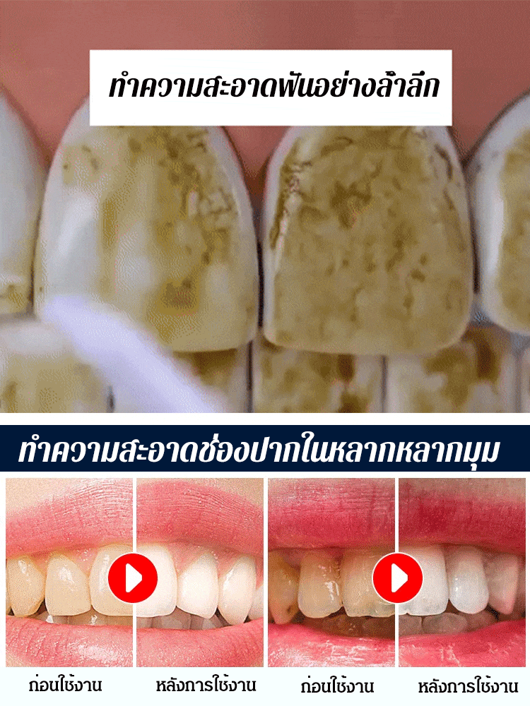 【ใช้ได้กับผู้ใส่เหล็กดัดฟัน】ไหมขัดฟันพลังน้ำอัลตราโซนิกแบบยืดหดได้