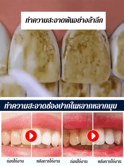 【ใช้ได้กับผู้ใส่เหล็กดัดฟัน】ไหมขัดฟันพลังน้ำอัลตราโซนิกแบบยืดหดได้